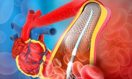 What is Stent? When its needed? Myths & Facts