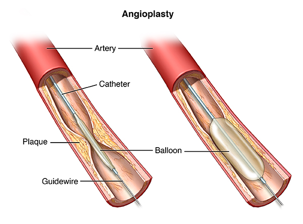 Angioplasty: What Is It, Experience, Risks, And Recovery?