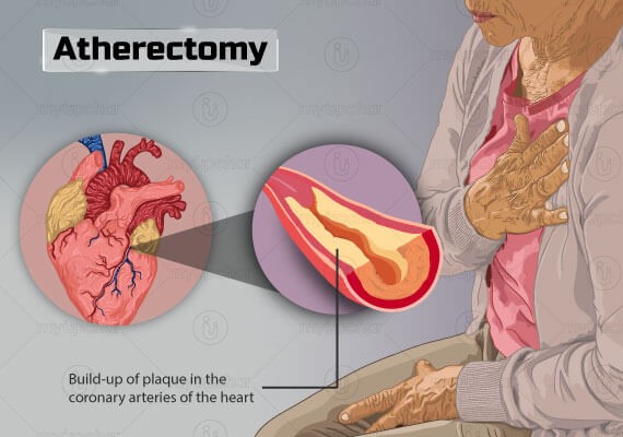 Atherectomy: What is it, Types, Procedure and Recovery.
