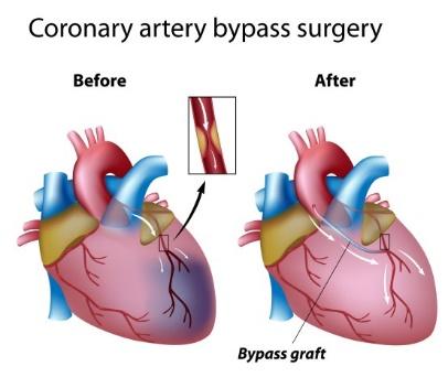 Bypass Surgery(CABG) : What is it, types, Procedures  Risks and Recovery.