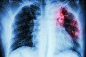 Tackling Pulmonary Tuberculosis: Causes, Symptoms, and Treatment